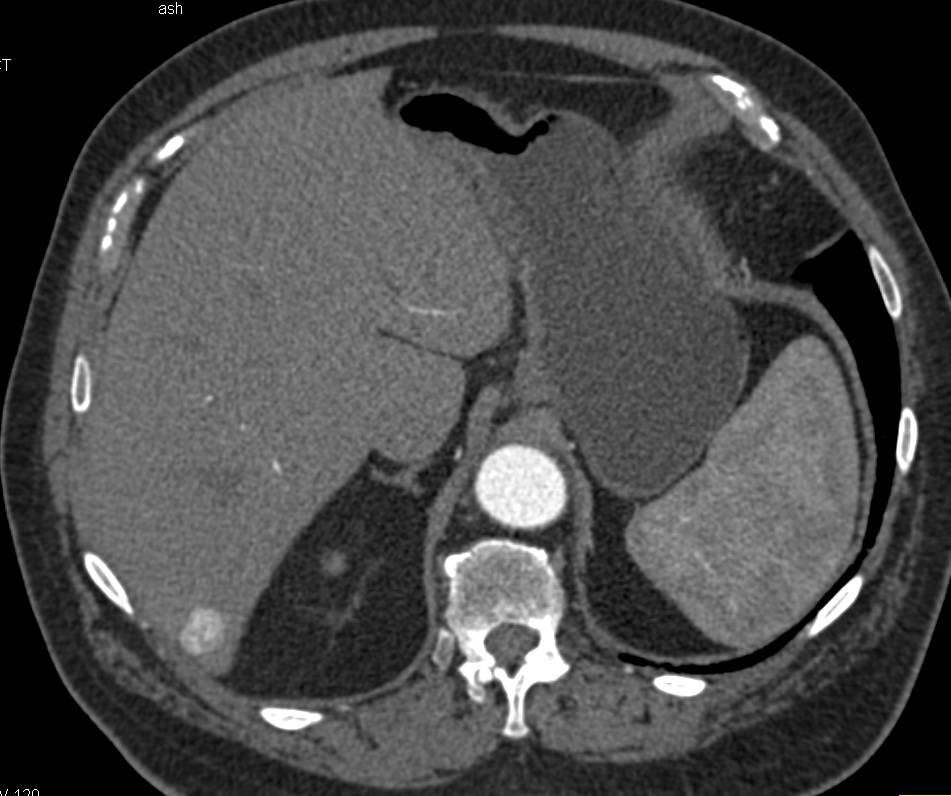 Atypical Hemangioma in the Right Lobe of the Liver - CTisus CT Scan