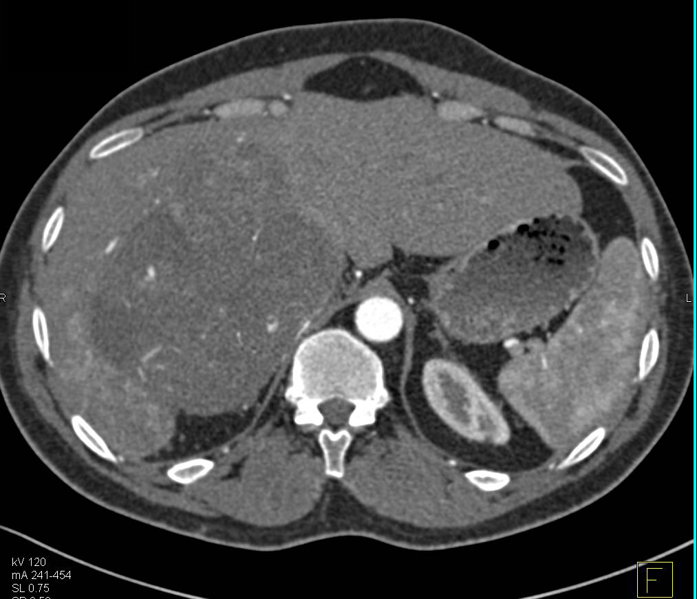 Hepatocellular Carcinoma (Hepatoma) with Neovascularity Arising in a Cirrhotic Liver. Arteriovenous (AV) Shunting Also Seen - CTisus CT Scan