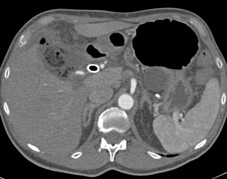 Abscess in the Gallbladder Fossa - Liver Case Studies - CTisus CT Scanning