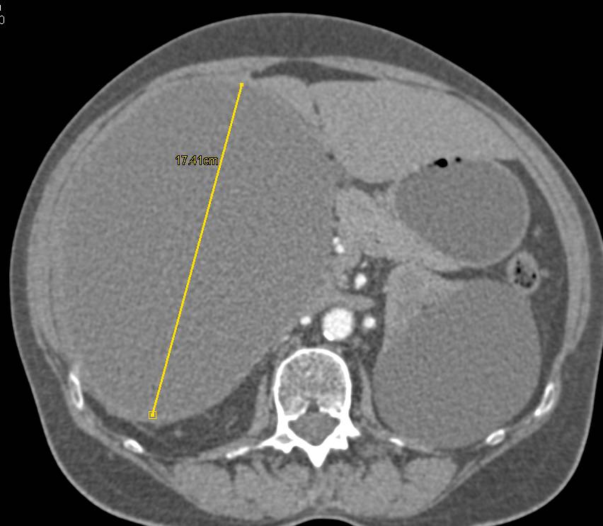 Simple Hepatic Cyst - CTisus CT Scan