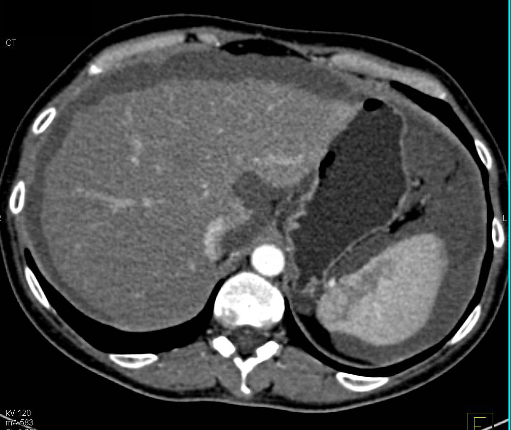 Pseudomyxoma Peritonei (PMP) with Extensive Tumor and Scalloping of the Liver Surface - CTisus CT Scan