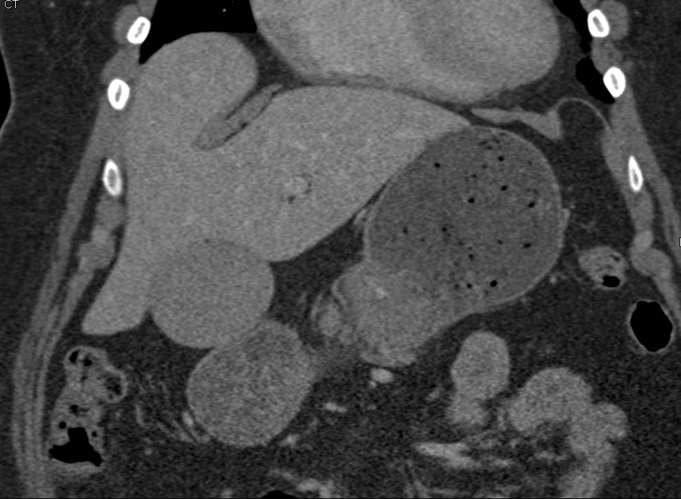 Dilated Gallbladder with Stones in Neck of Gallbladder - CTisus CT Scan