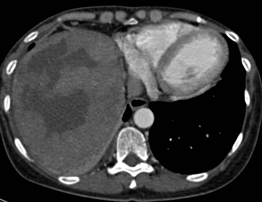 Mesenchymal Tumor of the Liver - CTisus CT Scan