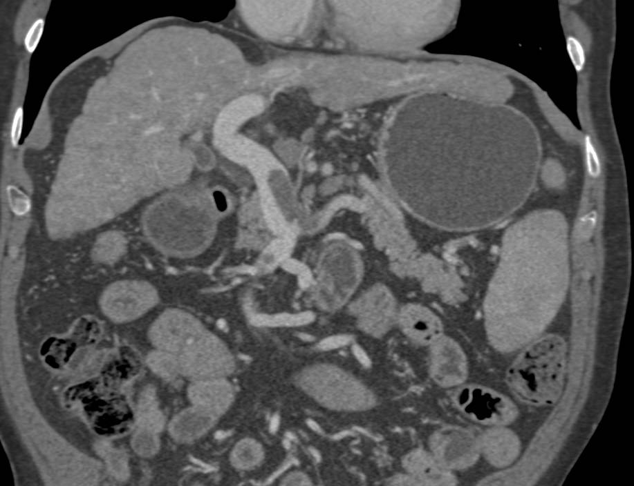 Cirrhosis with 3D Mapping of Partial Thrombosis of Portal Vein, Superior Mesenteric Vein (SMV) and Splenic Vein - CTisus CT Scan