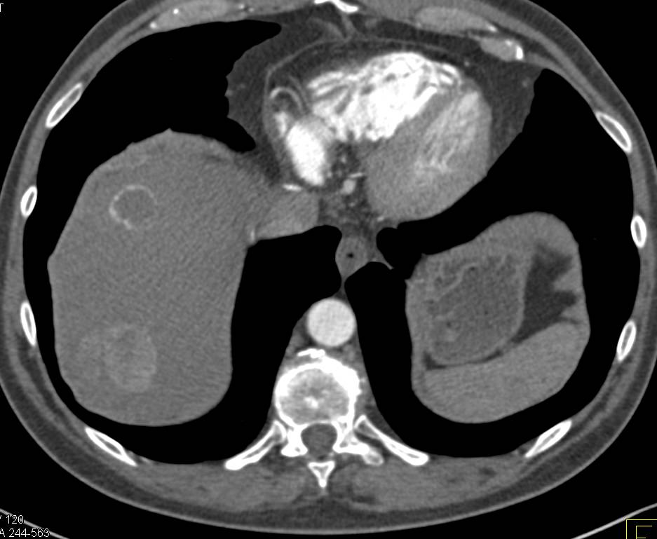 Metastatic Carcinoid tumor to the Liver with Hypervascular Lesions Shown on All Phases - CTisus CT Scan