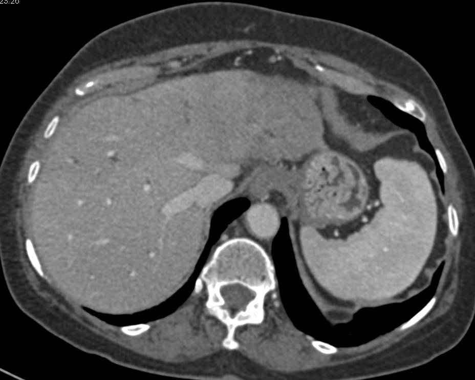 Cholangiocarcinoma with Portal Hypertension - CTisus CT Scan