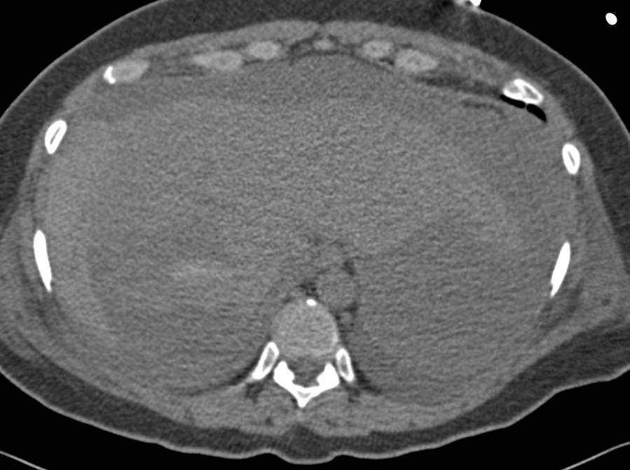 Hemoperitoneum due to Bleeding from the Liver - CTisus CT Scan