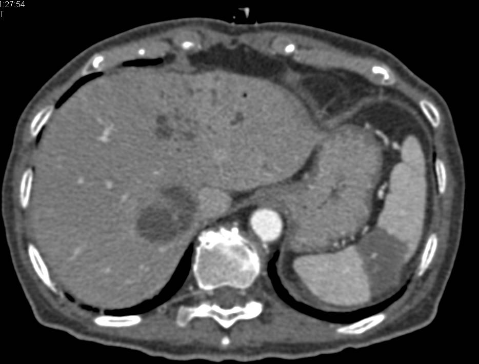 Cholangiocarcinoma and Splenic Infarct - CTisus CT Scan