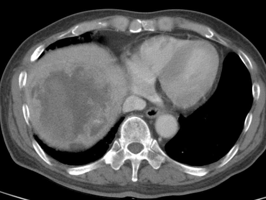 Hepatocellular Carcinoma (Hepatoma) with Spontaneous Bleed - CTisus CT Scan