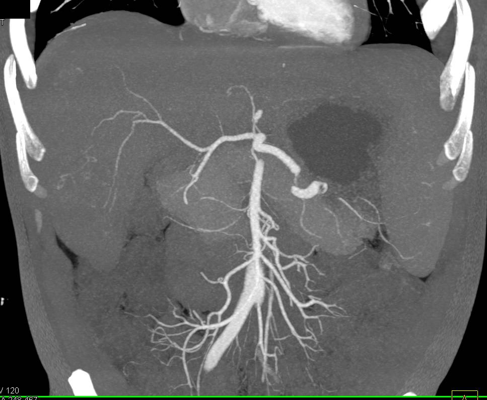 Hepatocellular Carcinoma (Hepatoma) Arises in a Cirrhotic Liver. Portal Hypertension with Varices are seen - CTisus CT Scan