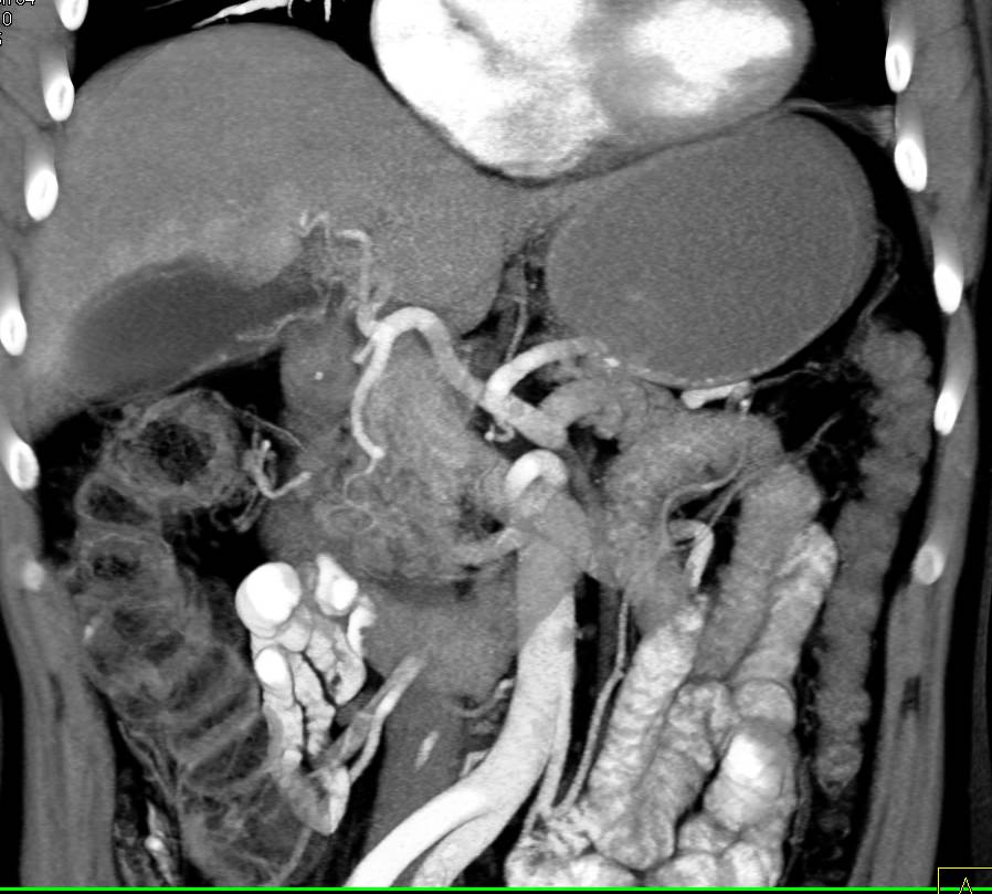 Perfusion Changes Around the Gallbladder in the Liver Means Acute Cholecystitis - CTisus CT Scan