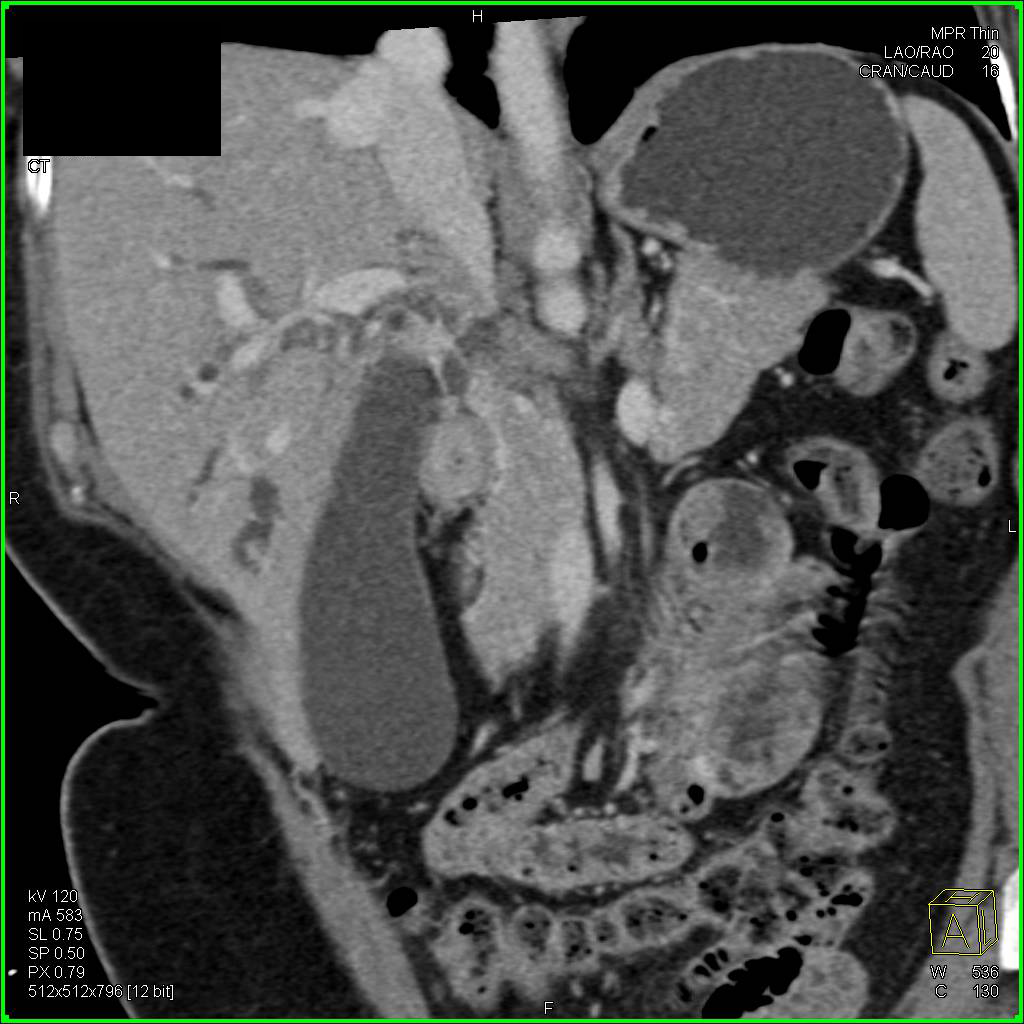 Carcinoma of the Common Bile Duct - CTisus CT Scan