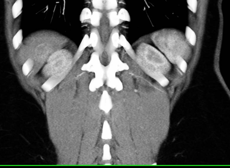 Vascular Liver Metastases - CTisus CT Scan