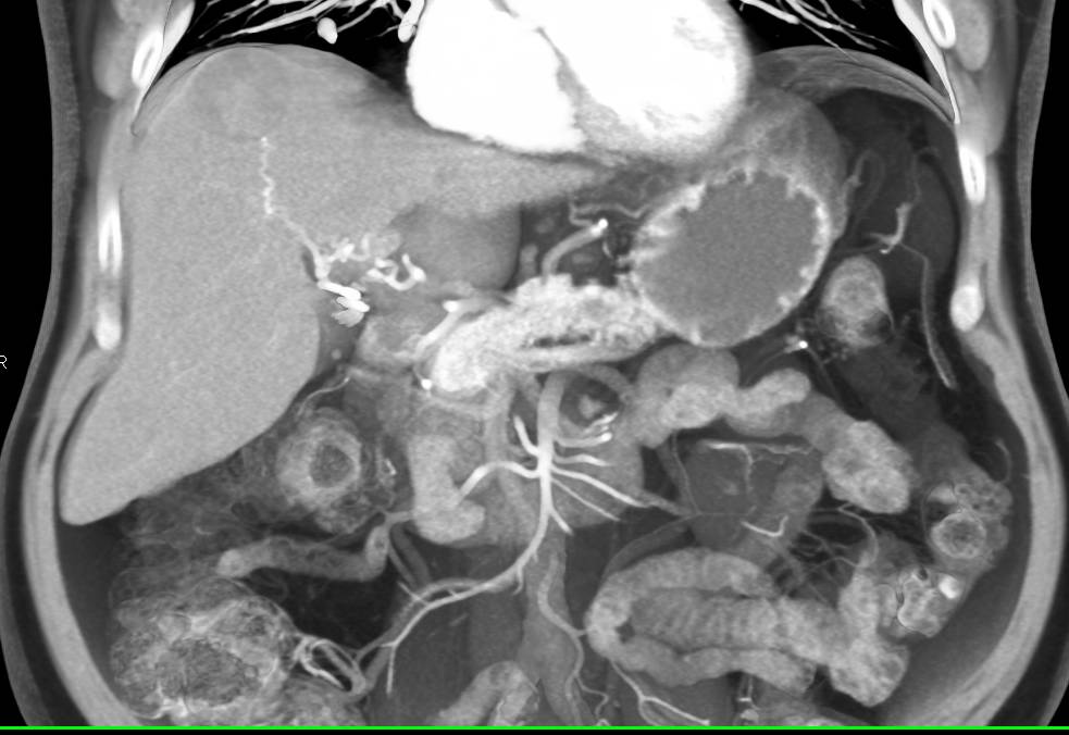 Hepatocellular Carcinoma (Hepatoma) with Neovascularity - CTisus CT Scan