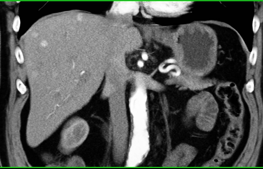 Vascular Liver Metastases from a Renal Cell Carcinoma - CTisus CT Scan