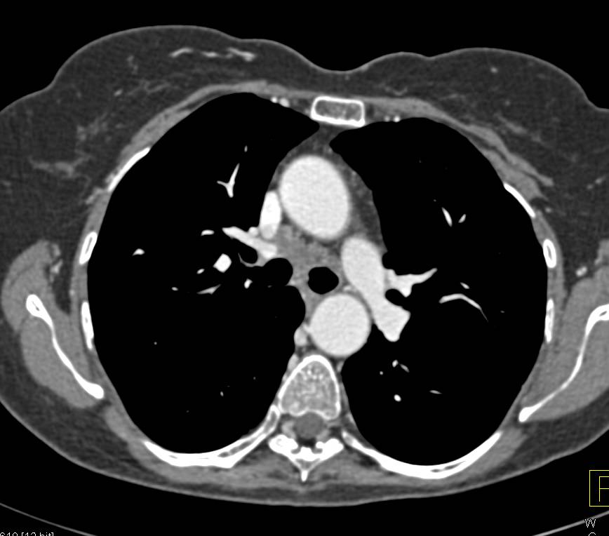 Metastatic Renal Cell Carcinoma to the Liver with Bulls eye Metastases and Mediastinal Adenopathy - CTisus CT Scan