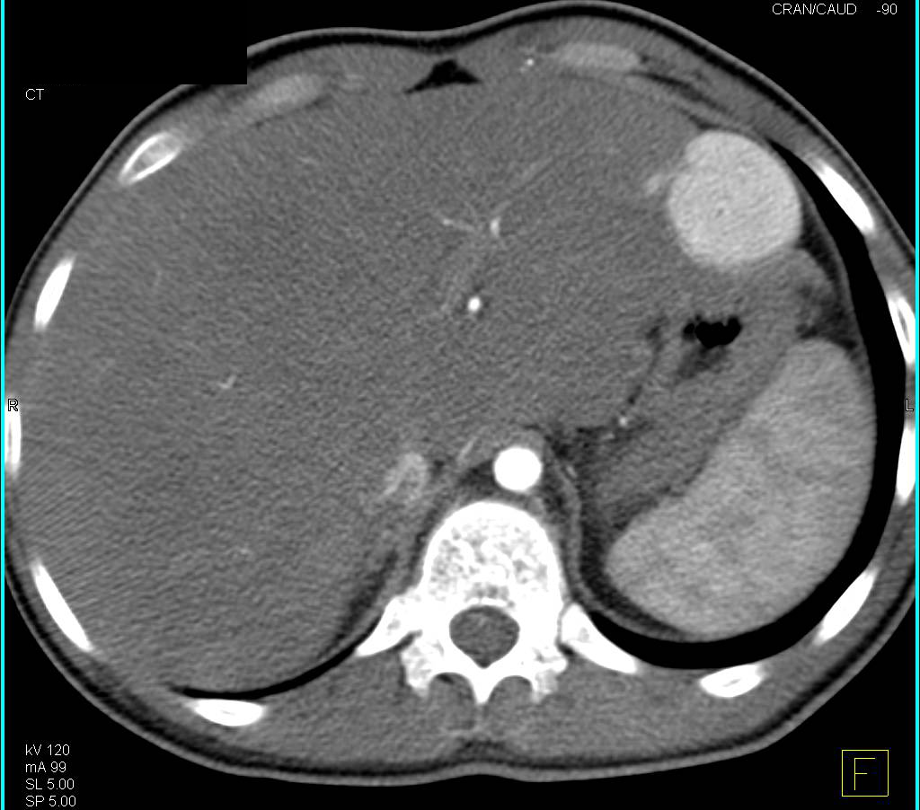 Unusual Case of Multiple Focal Nodular Hyperplasias (FNHs) in a Younger Male - CTisus CT Scan