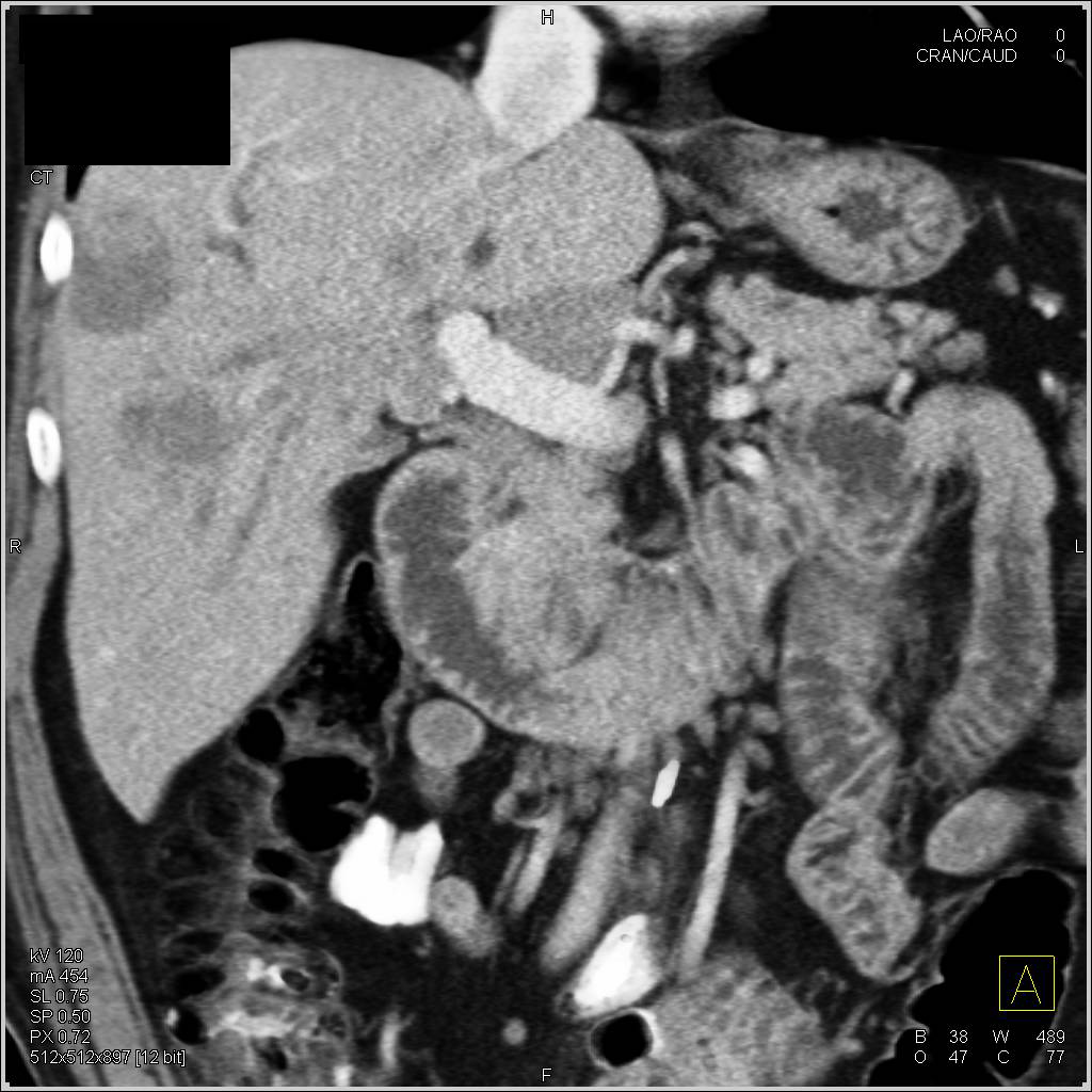 Cholangiocarcinoma - CTisus CT Scan