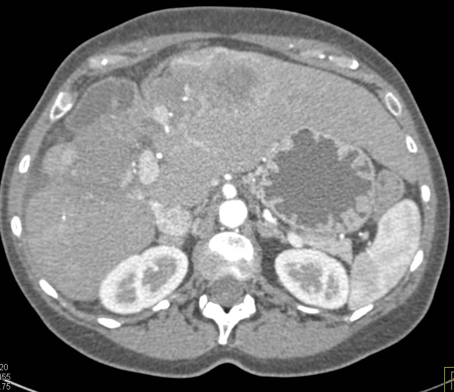 Hepatocellular Carcinoma (Hepatoma) - CTisus CT Scan