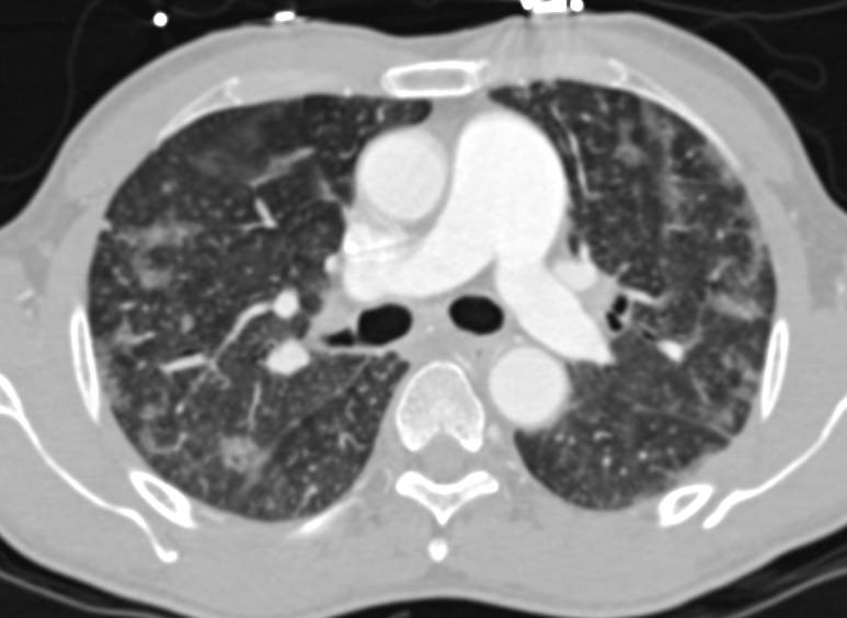 Nonvascular Neuroendocrine Tumor with Liver Metastases and Ascites - CTisus CT Scan