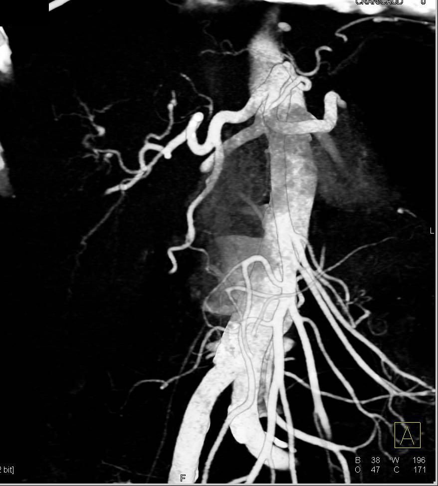 Hepatocellular Carcinoma (Hepatoma) with Neovascularity - CTisus CT Scan