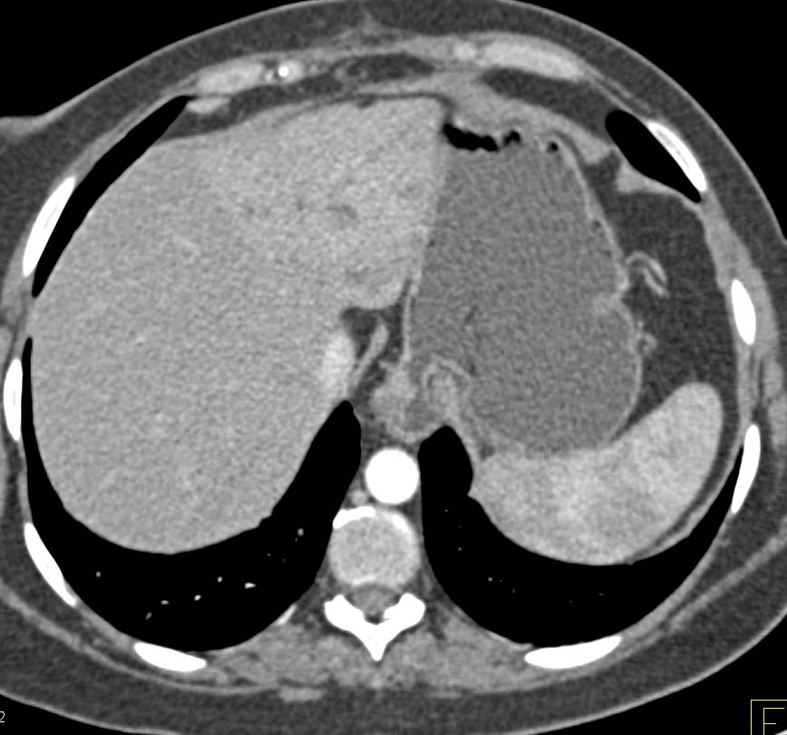 Cholangiocarcinoma Left Lobe of Liver in Multiple Phases - CTisus CT Scan