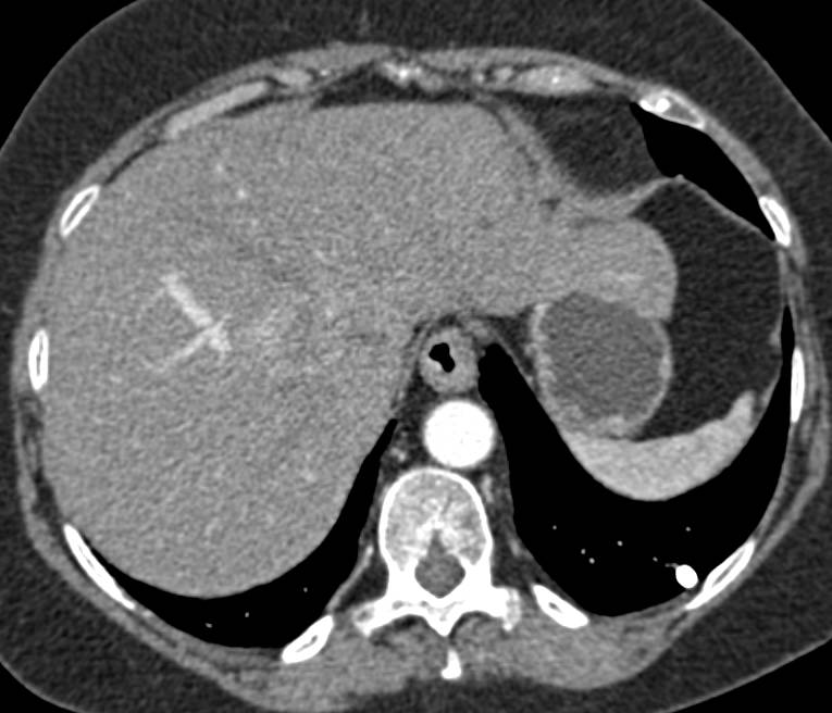 Subtle Liver Metastases from Colon Cancer - CTisus CT Scan