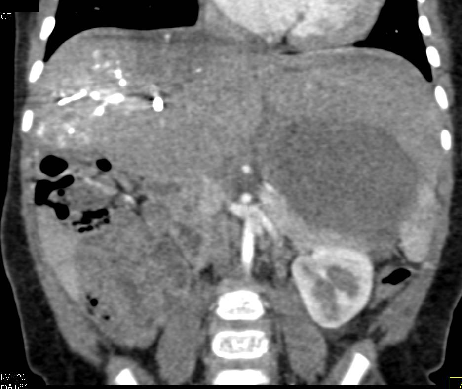 Hepatic Necrosis Following Portal Vein Embolization - CTisus CT Scan