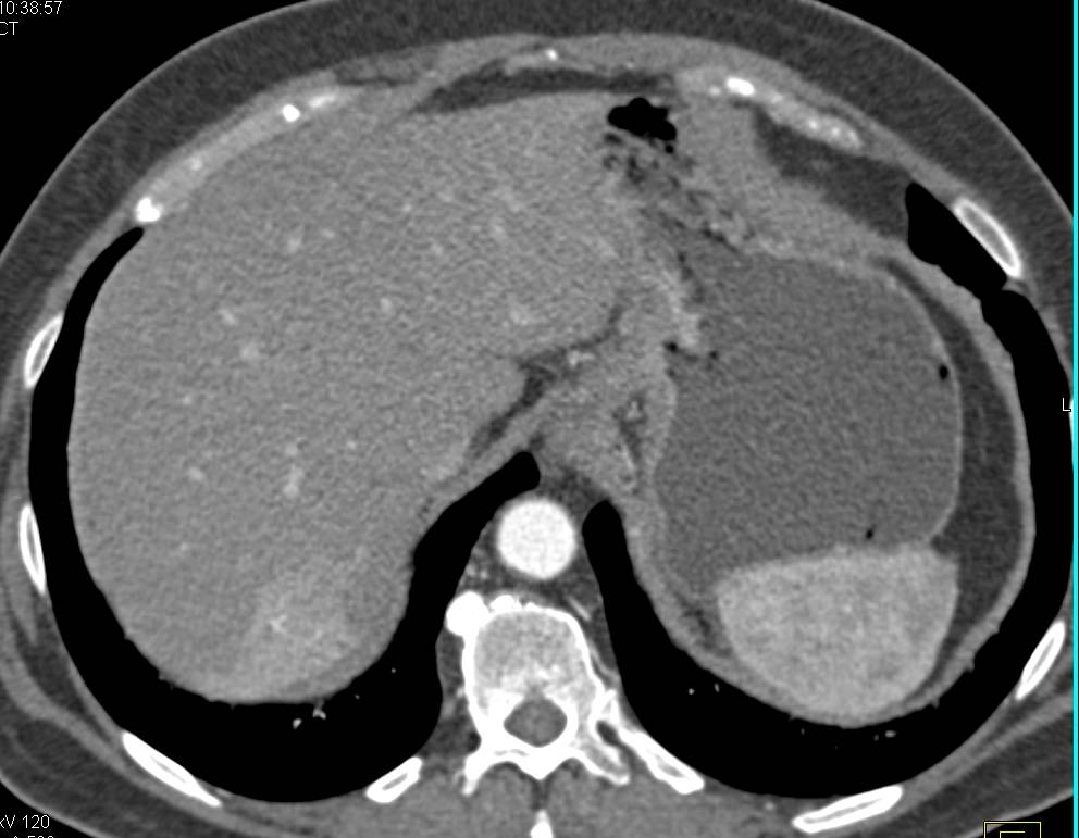 Hepatic Hemangioma - CTisus CT Scan