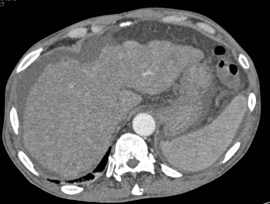 Cirrhosis and Portal Hypertension with ESLD - CTisus CT Scan