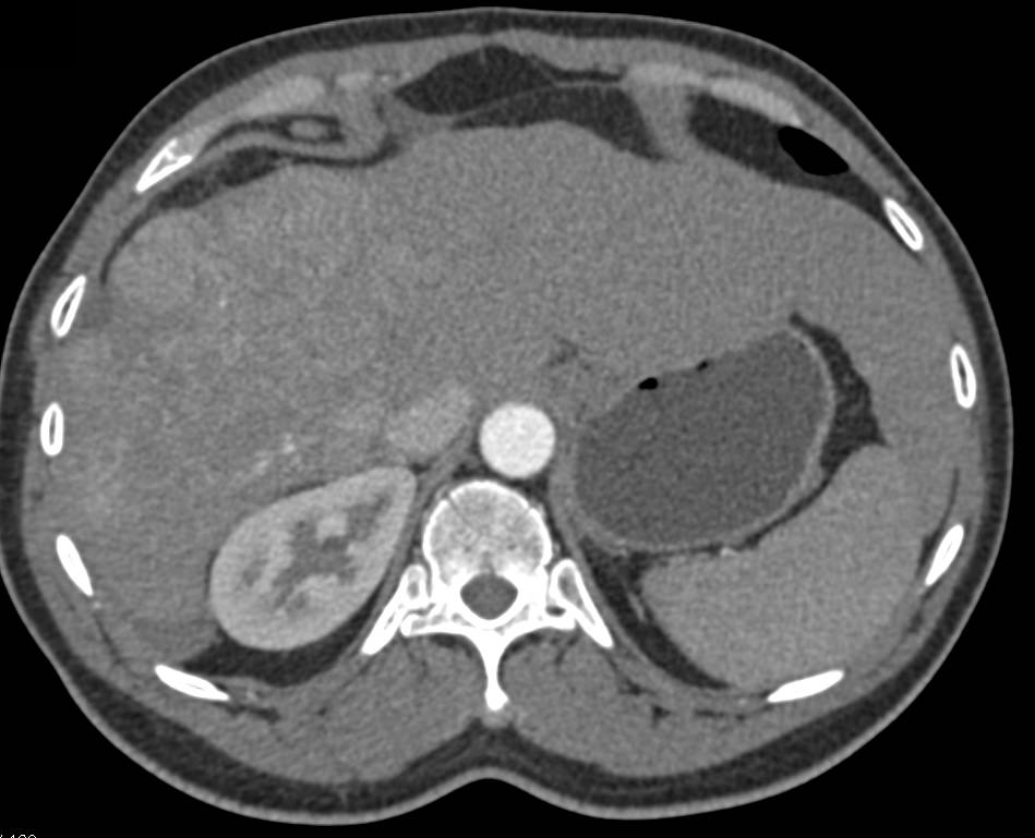 Hepatocellular Carcinoma (Hepatoma) with Neovascularity Arising in a Cirrhotic Liver - CTisus CT Scan