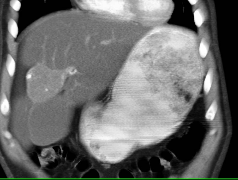 An Area of Fatty Sparing and Scarring in a Fatty Liver Simulates a Neoplasm - CTisus CT Scan