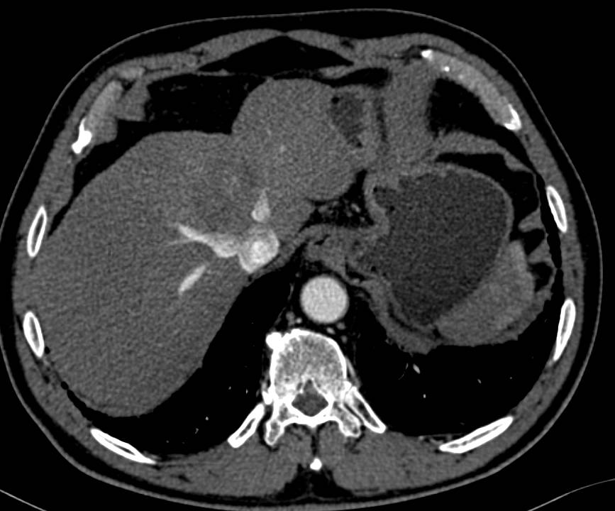 Hypovascular Hepatocellular Carcinoma (Hepatoma) - CTisus CT Scan