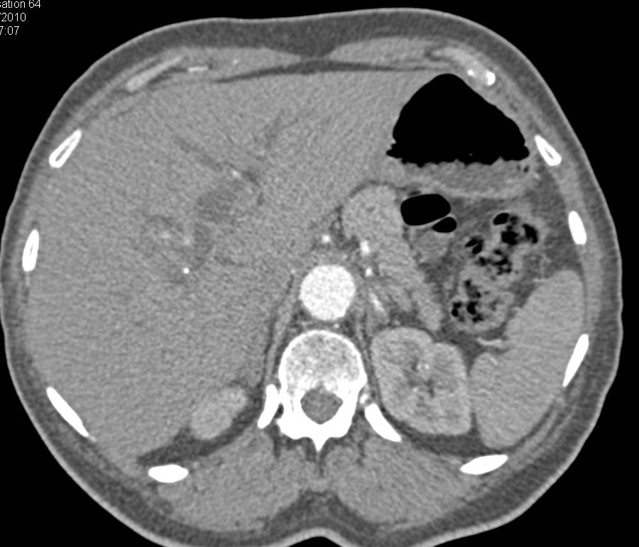 Dilated Common Bile Duct due to Ampullary Tumor - CTisus CT Scan