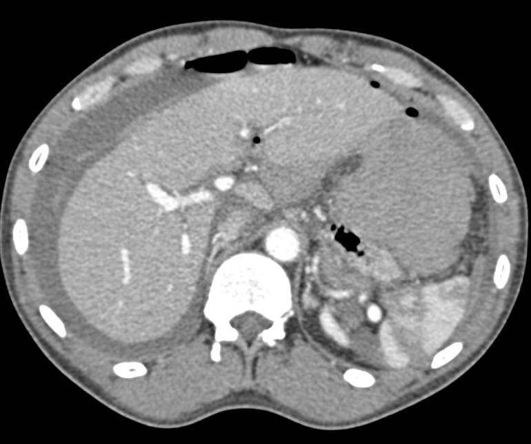 Hemoperitoneum due to Bleeding from the Liver as well as Pneumoperitoneum - CTisus CT Scan