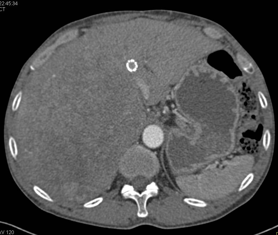 Infiltrating Hepatocellular Carcinoma (Hepatoma) - CTisus CT Scan