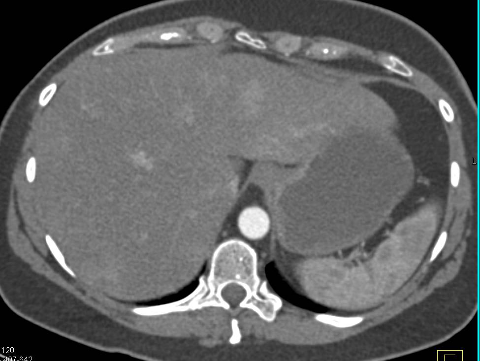 Islet Cell Tumor with Metastases to the Liver - CTisus CT Scan