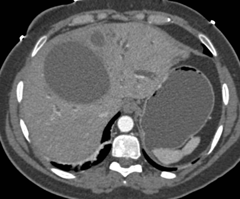 Large Biloma.  Looks a bit Like a Choledochal Cyst - CTisus CT Scan