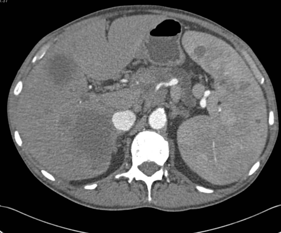 Lymphoma Involves the Liver and Spleen and Well as Extensive Nodes Especially Around the Pancreas - CTisus CT Scan