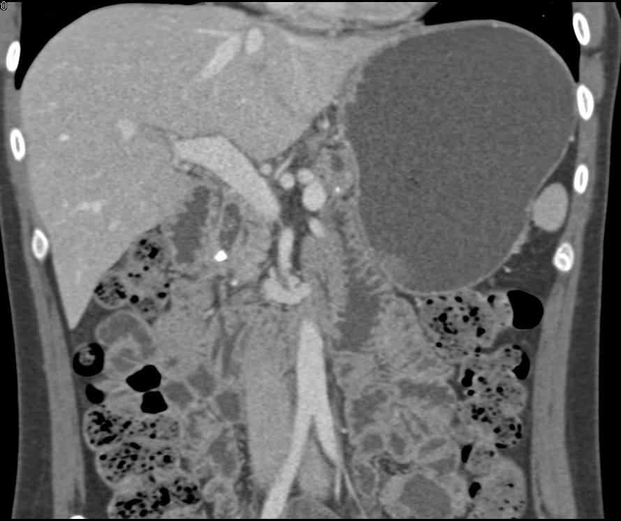 Multiple Common Duct Stones Causing Obstruction - CTisus CT Scan