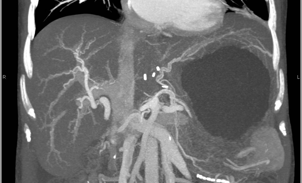 CTA of Cirrhosis of the Liver - CTisus CT Scan