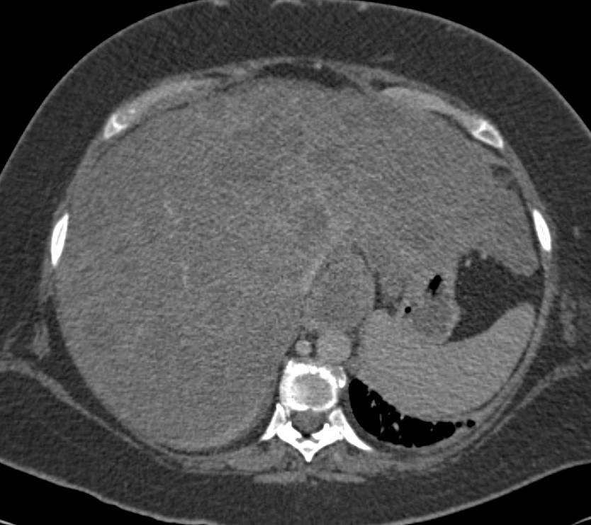 Liver Metastases in a Fatty Liver - CTisus CT Scan