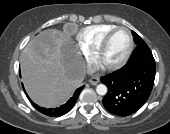 Hepatocellular Carcinoma (Hepatoma) with Paracardiac Nodes - CTisus CT Scan