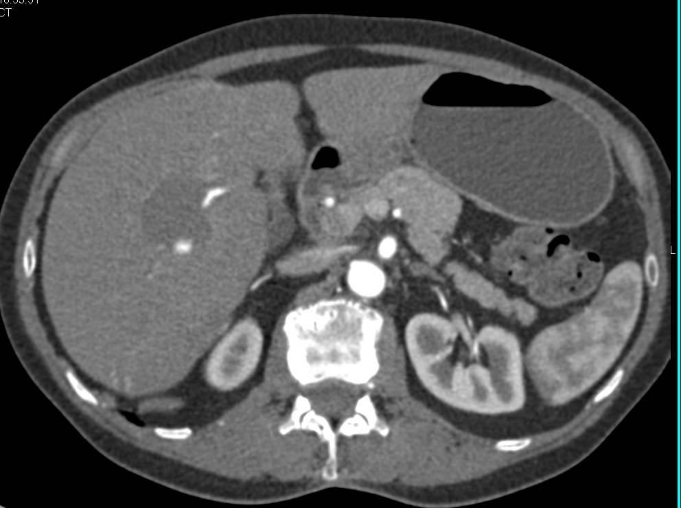 Hepatic Hemangiomas - CTisus CT Scan