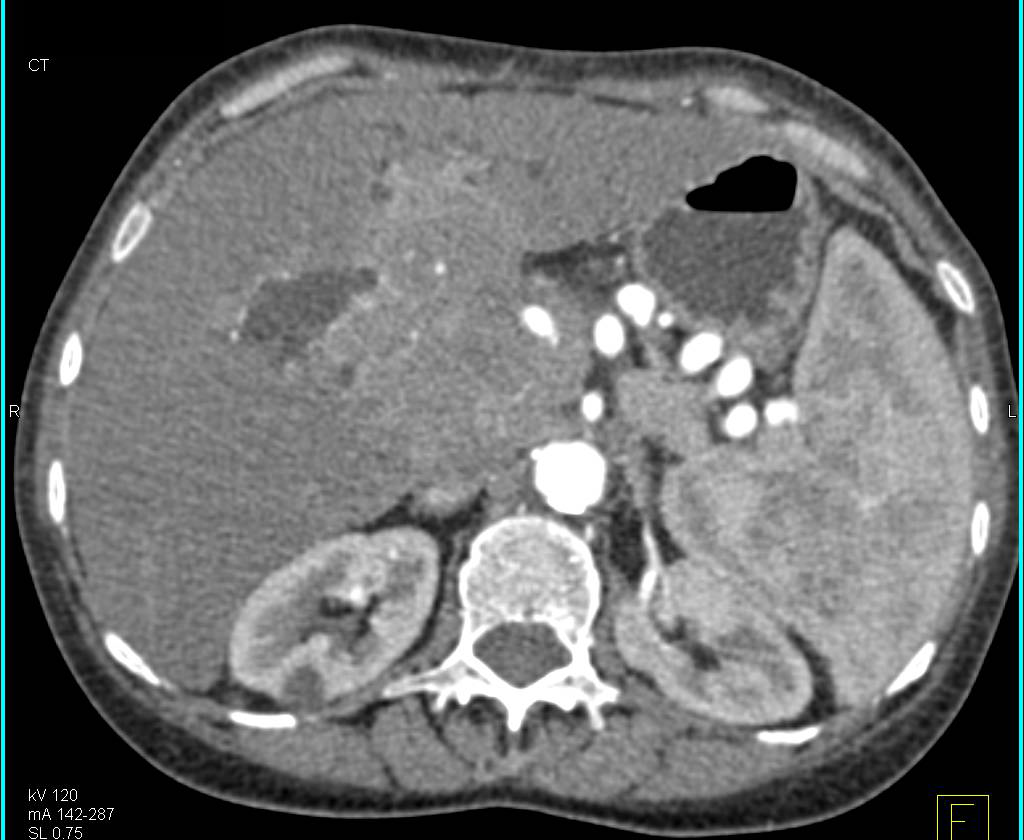 Central Cholangiocarcinoma Encases the Portal Vein and Hepatic Artery - CTisus CT Scan