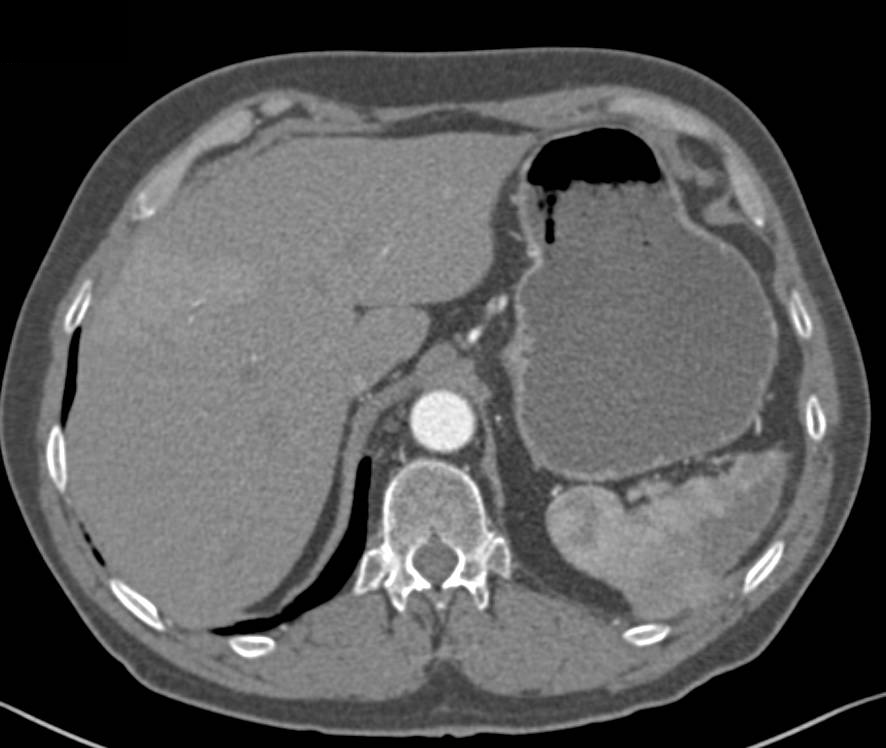 Perfusion Changes in Right Lobe of the Liver - CTisus CT Scan