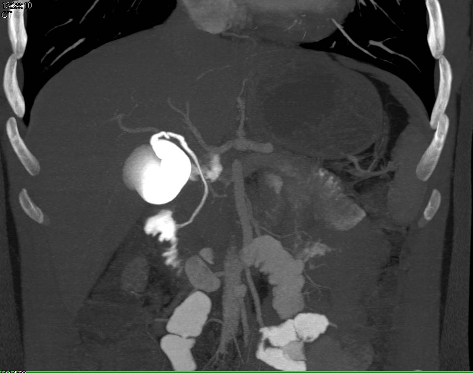 Post Endoscopic Retrograde Cholangiopancreatography (ERCP) with Nice Demonstration of the Common Bile Duct and Cystic Duct - CTisus CT Scan