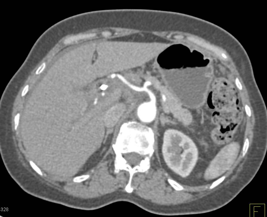 Gallbladder Cancer Wich is Invasive into Porta Hepatitis with Local Adenopathy as Well - CTisus CT Scan