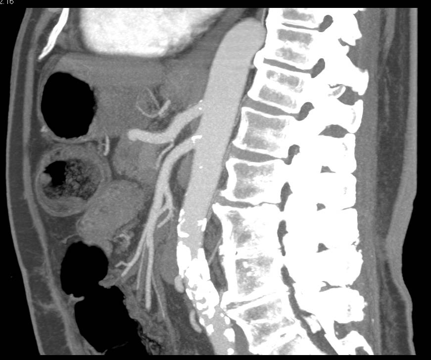 Double Duct Sign with Ampullary Carcinoma - CTisus CT Scan