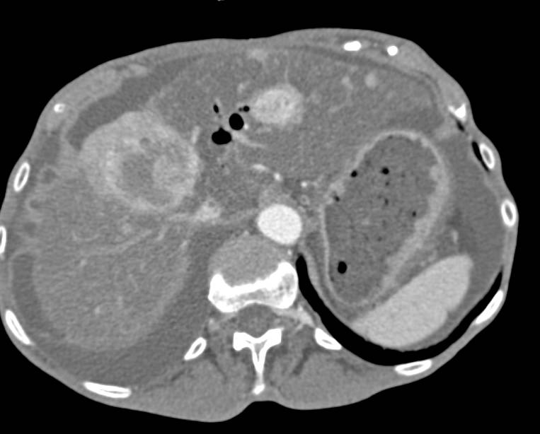 Metastatic Carcinoid Tumor to the Liver with Hypervascular Lesions Shown on All Phases - CTisus CT Scan